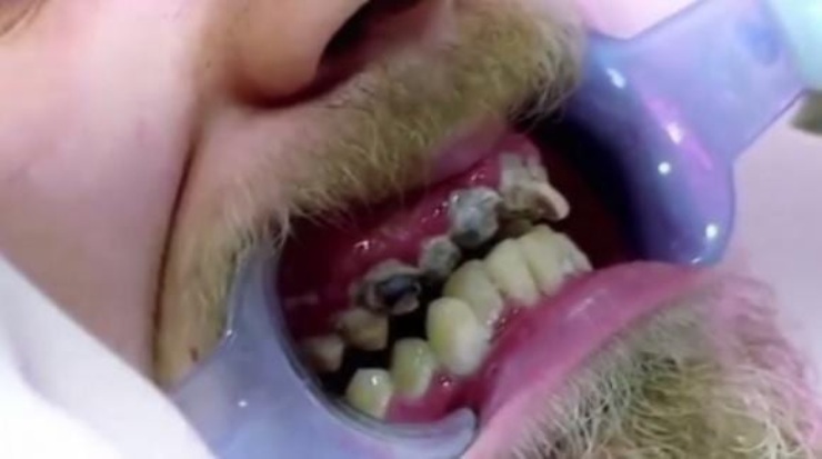 La bocca dell'uomo che non ha lavato i suoi denti per 20 anni